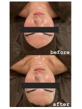 エングロー(Englow)/絶対美白！話題の復元パック