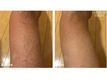 セラス(CERAS)/男性の足脱毛