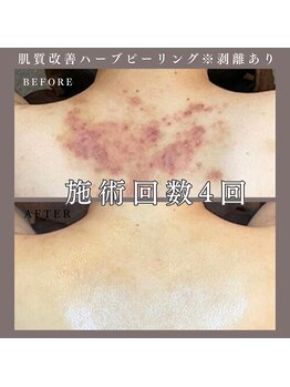 ベルミー(Bellmi)/肌質改善ハーブピーリング(背中)