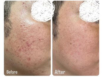 コンフィデンスサロン(Confidence Salon)/赤いニキビケア！