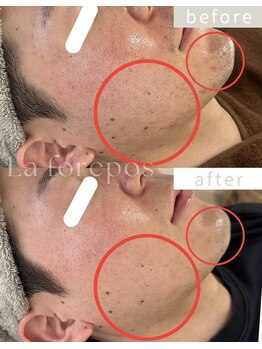 ラ フォルポ 恵比寿(La forepos)/veruna無農薬ハーブピーリング