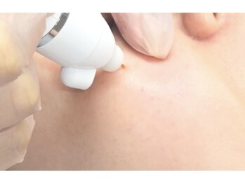 ビジュー(BIJOU)/シミケア