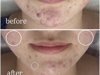 アンリミット 鹿児島天文館店(Une limit)/顎の手強いニキビに