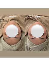 WA ネイル アンド ビューティー(WA nail & beauty)/小顔コルギ