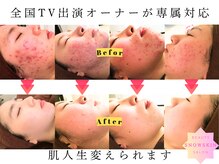 スノースキン(Snow skin)