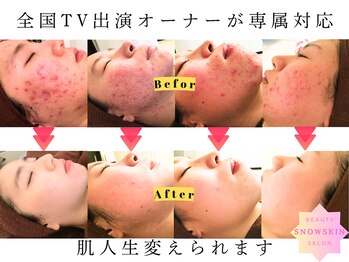 スノースキン(Snow skin)