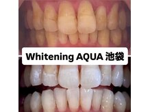 アクア 池袋店(AQUA)/ホワイトニング/池袋/東京/美白