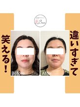 美顔デザインsuu.～若見えと歪み矯正専門の小顔サロン～/Before-After【40代】12 回