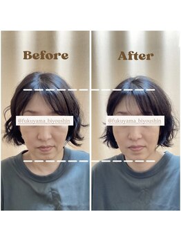 大門鍼灸整骨院/美容鍼施術後ビフォーアフター