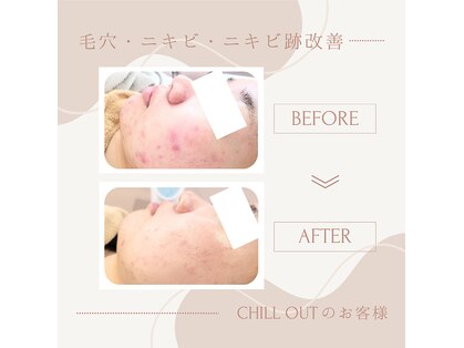チル アウト(CHILL OUT)の写真