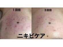 ビューティーネイル(Beauty Nail)/エクストラクション