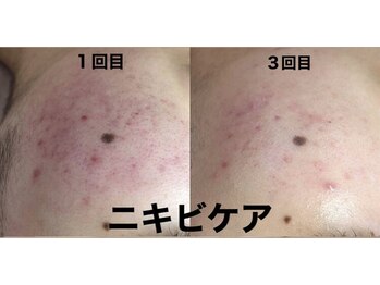 ビューティーネイル(Beauty Nail)/エクストラクション