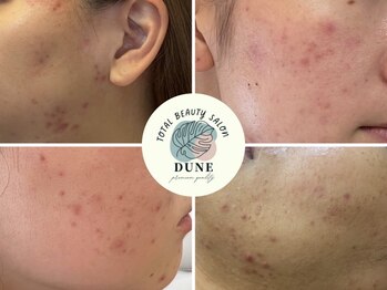デューン 蕨店(Dune)/ニキビケア専門店