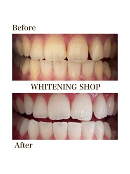 ホワイトニングショップ 川越店/【Before After】