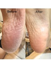 プラスワン(+1)/フット本物の角質ケア