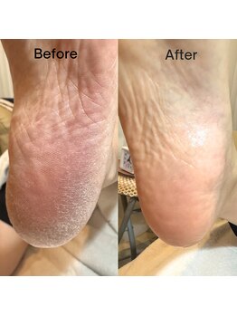 プラスワン(+1)/フット本物の角質ケア