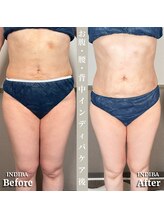 術後の女神 大阪心斎橋店/術後ケアインディバ・インディバ