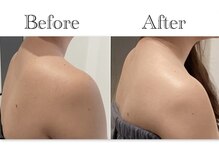 ルシェビューテイー(Luche Beauty)/肩周りスッキリ！