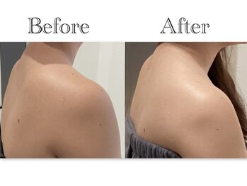 ルシェビューテイー(Luche Beauty)/肩周りスッキリ！