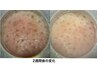 【お悩み別★毛穴・黒ずみ・角栓】あなただけの改善プランご提案¥7000～20000