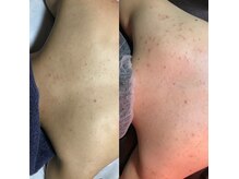 ブライダルエステにオススメ背中のケア