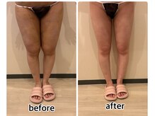 インディバジェム(GEM)/ビフォーアフター