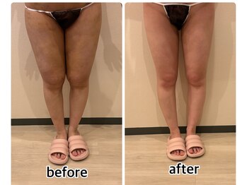 インディバジェム(GEM)/ビフォーアフター