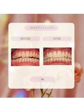 プラスビー 2号店(+b)/ホワイトニングビフォーアフター
