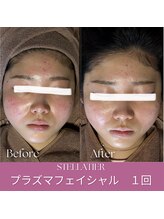 ステラティエ(Stellatier)/ニキビ/乾燥肌/肌荒れ/赤み