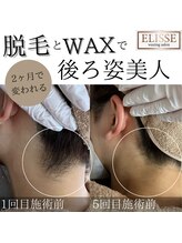 エリス(ELISSE)/脱毛とwaxで後ろ姿美人