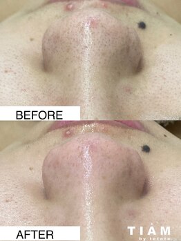 ティアム バイ テトテ 神戸三宮(TIAM by tetote)/毛穴洗浄 水光ジェット