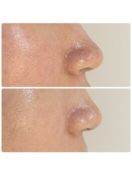 ル シェリア(Le Cherien)/毛穴洗浄+ハーブピーリング