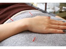 ウェルビープラーカ(Well-beプラーカ)/施術の流れ(４)お身体への鍼