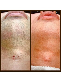 リアンジュ/ヒゲ脱毛の経過