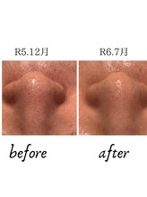 エムフルール(M fleur)/毛穴洗浄コース4900円