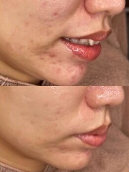 ホワイトアクア 明石店(WHITE AQUA)/ララピール/ニキビケア/シワケア