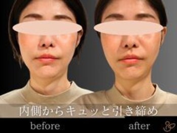 チョコバリ 郡山店(chocobari)/小顔×リフトアップ(美容鍼)20代