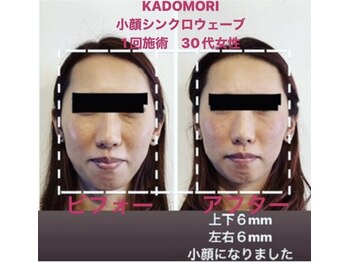 ハナゾノ鍼灸院(HANAZONO鍼灸院)/小顔美容鍼フルコース