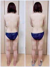 ヨサパーク モカ(YOSA PARK Moca)/1回の施術でこの変化！