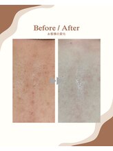 ラヴィ コロレ(La vie colore)/背中脱毛×光フェイシャル