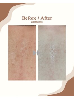 ラヴィ コロレ(La vie colore)/背中脱毛×光フェイシャル