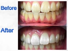 LBSホワイトニング 梅田店/ホワイトニングビフォーアフター