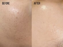 コア(Coeur)/【艶肌爆誕】lamination peeling