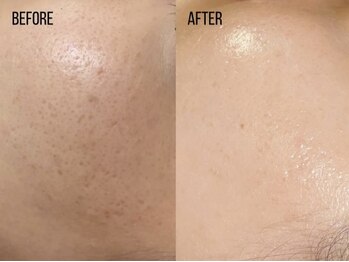 コア(Coeur)/【艶肌爆誕】lamination peeling