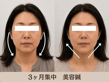 ピュアハリ/年齢のせいと諦める前に美容鍼