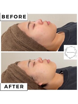 サロン ド パーフェクション(Salon de Perfection)/小顔リフト