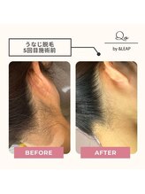 キュオバイアンドリープ(Qo by &LEAP)/うなじ脱毛