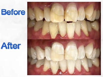 LBSホワイトニング 梅田店/ホワイトニングビフォーアフター
