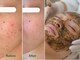 ラメールブルー(La Mer Bleue)の写真/ハーブ専門店が本気のニキビケア【ハーブピーリング体験★￥6600】くり返す肌荒れ悩みに◎結果出しに自信！