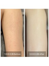 癒える(ielu)/二の腕のプツプツもハーブで★